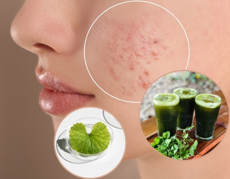 Trị thâm mụn bằng rau má Trị thâm mụn bằng rau má
